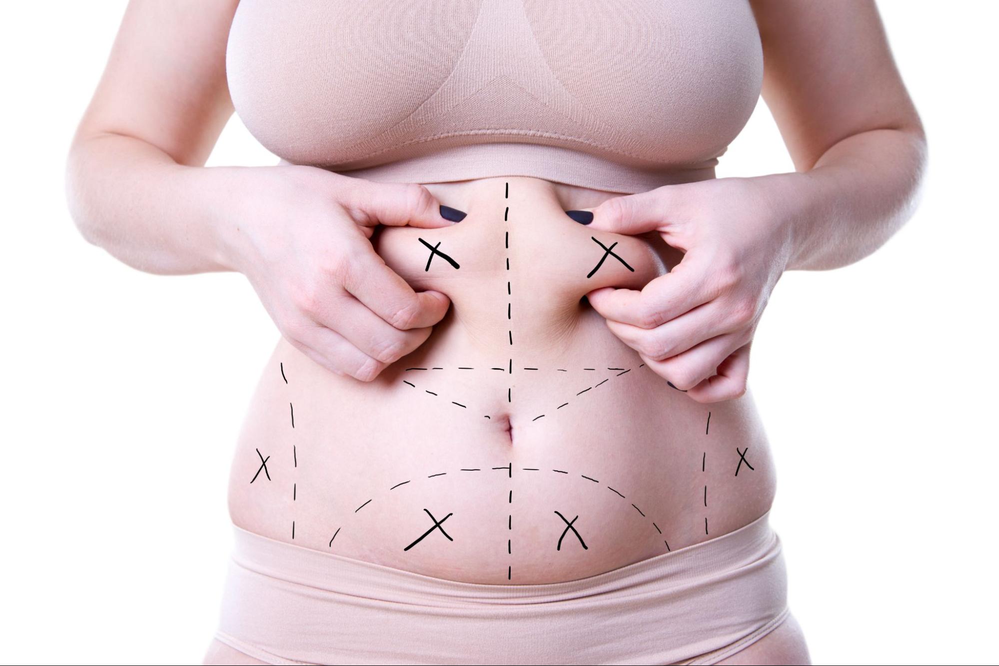 Liposuction Austin